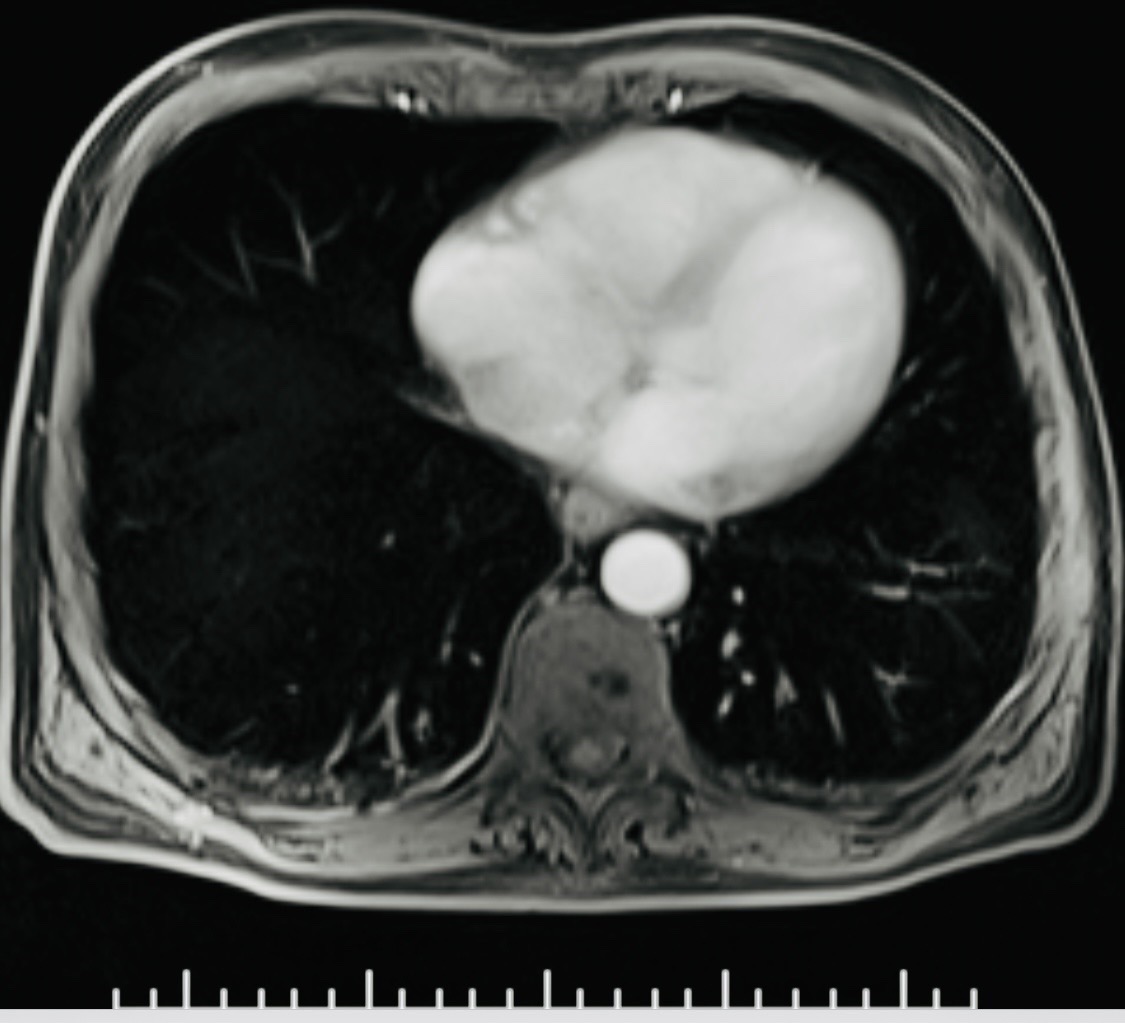 Chest MRI example used to illustrate thoracic cancer imaging